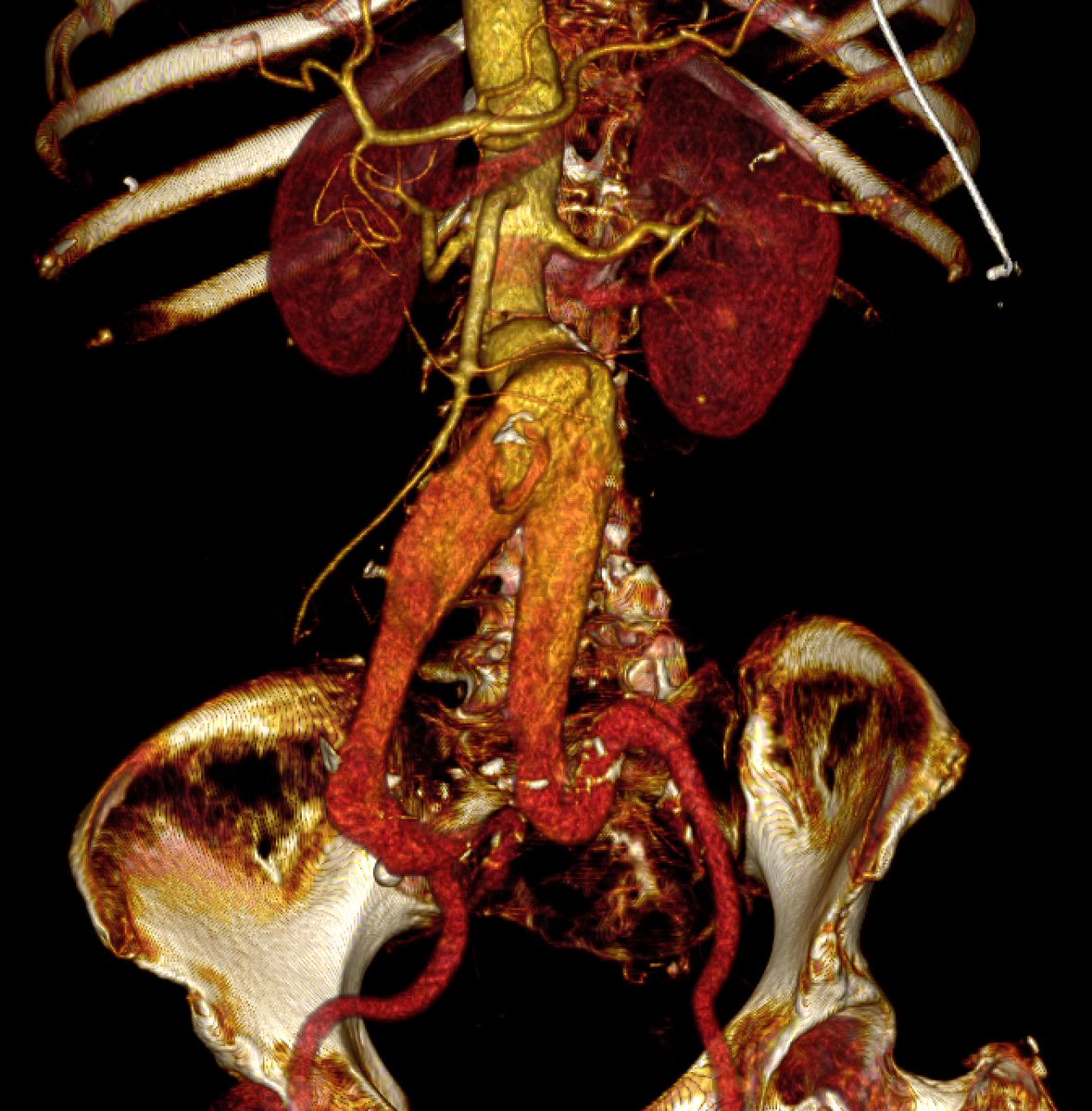 André Brito Queiroz (@andrebrq) on Twitter photo The thrombus can create a new aortic bifurcation! #AortaEd <a href="/Leocortizo1/">Leonardo Cortizo, MD</a> <a href="/jpcarvalho_vasc/">João Pedro Carvalho, MD</a> <a href="/fonseca_alan5/">Alan Fonseca</a> The thrombus can create a new aortic bifurcation! #AortaEd <a href="/Leocortizo1/">Leonardo Cortizo, MD</a> <a href="/jpcarvalho_vasc/">João Pedro Carvalho, MD</a> <a href="/fonseca_alan5/">Alan Fonseca</a>