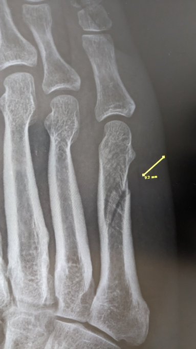 右足の骨が折れてました♥
腰ばっかり気にしてたら…_(:3」∠)_ 