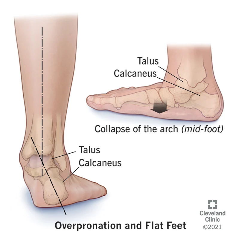 afrkml's tweet photo. "Knp telapak kaki sering sakit klo jalan jauh?"

Pernah gitu juga gak?
Penyebab terseringnya tuh krn Plantar Fasciitis, alias radang di plantar fascia (jaringan ikat tebal yg ngehubungin tumit ke jari kaki).

Risikonya meningkat klo kamu:
1. Punya kaki datar/lengkung kaki yg sangat tinggi
2. Kelebihan BB
3. Langkah kakimu cenderung masuk ke dalam (overpronasi)
4. Pake sepatu tanpa dukungan lengkung yg baik
5. Banyak jalan, lari, atau berdiri di permukaan keras
6. Nyeker
7. Hamil

Nah, kira2 penyebabmu yg mana tuh? Coba cek deh! 😆