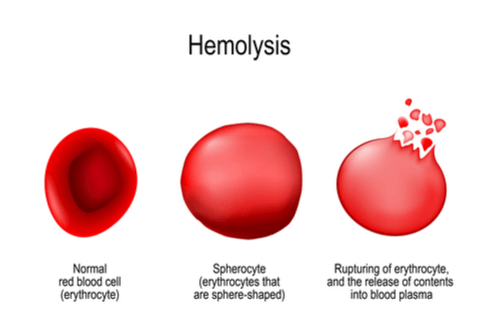 Hemolytic anemia is a kind of anemia characterized by an abnormal breakdown of red blood cells through hemolysis, whether intravascularly or partially outside the blood arteries. 
#Hemolyticanemia #redbloodcells #tumor #arteries #Immunology #erythrocyte #bloodplasma #endothelial