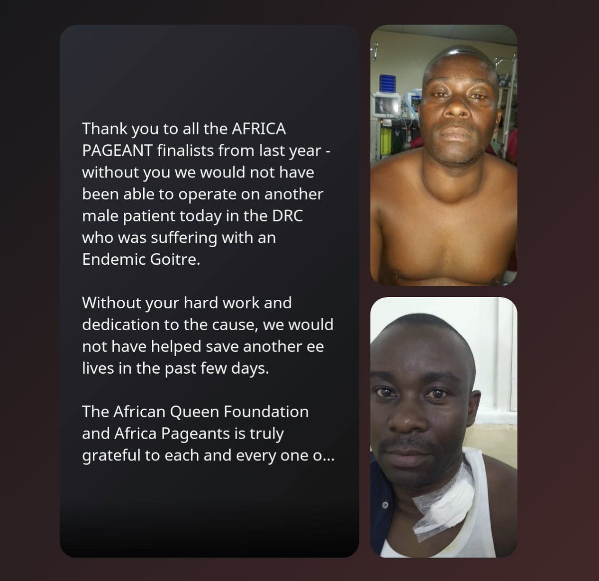 🙌 Six years ago, an incredible journey began, we embarked on a mission to save lives in the DRC. One story that touches our hearts deeply is that of a brave young man who needed a life-saving Goiter Operation in 2019.

💪 He was one among 19 individuals we supported.