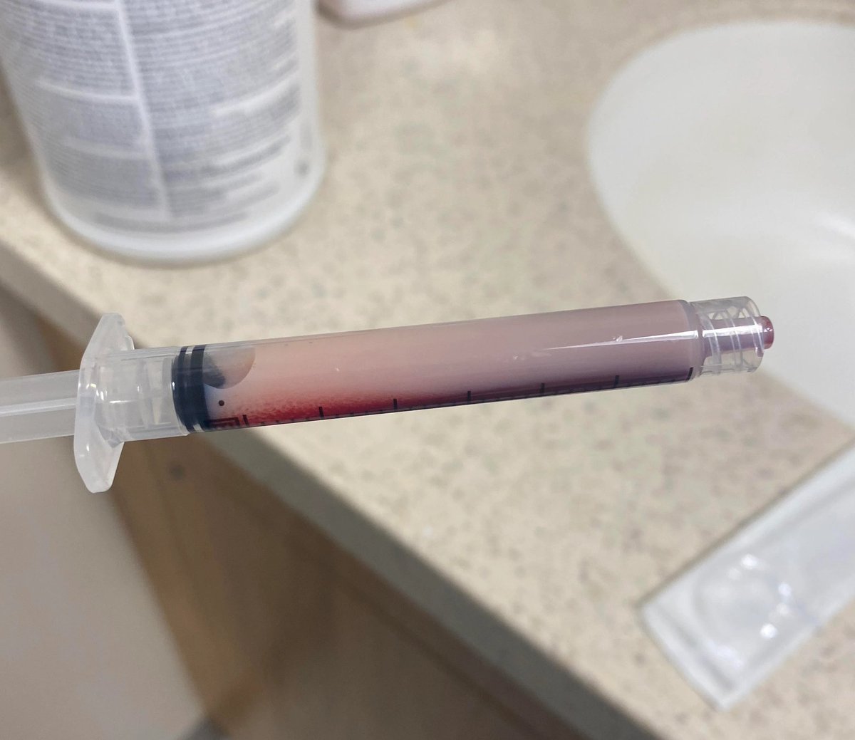 mishalmedico's tweet photo. Blood from a 5 year old with nephrotic syndrome

#MedTwitter https://t.co/uYECp8JAGE
