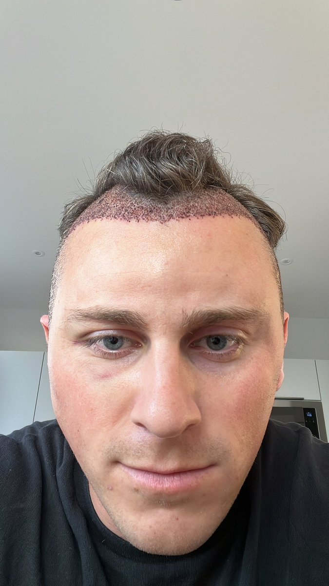 Got a hair transplant and look like Cartman from South Park