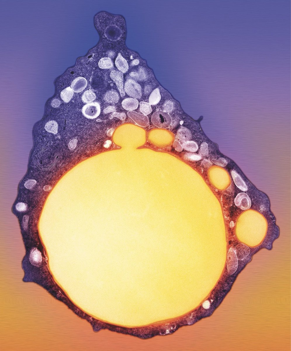 RossanaMelo5's tweet photo. This is not the sun!☀️It is a giant #LipidDroplet seen in the cytoplasm of an inflammatory eosinophil! Colorized EM image. #MicroscopyMonday #sciart #cellbiology https://t.co/qCeiFD6zj1