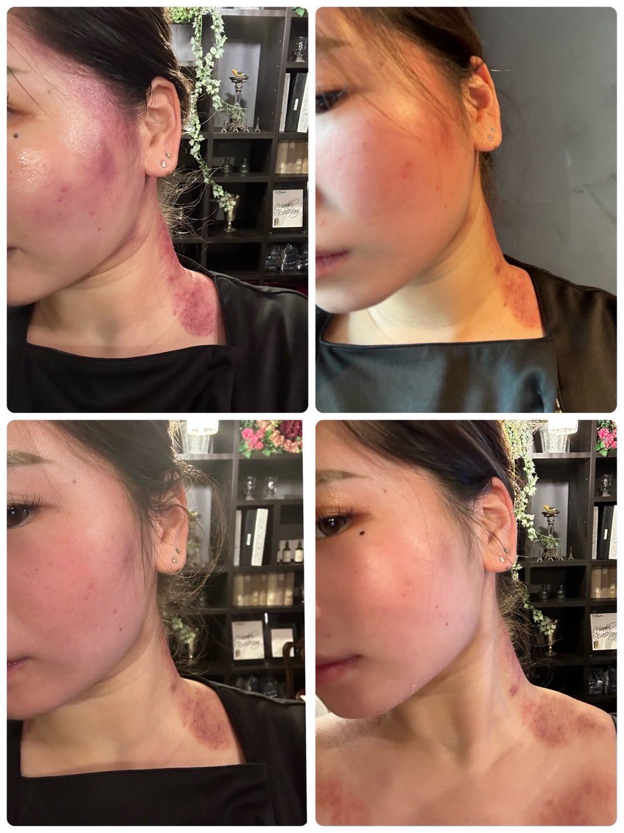 #切らない骨切り
1週間で　#胸鎖乳骨筋 が出た
骨切りなんてもう必要ない