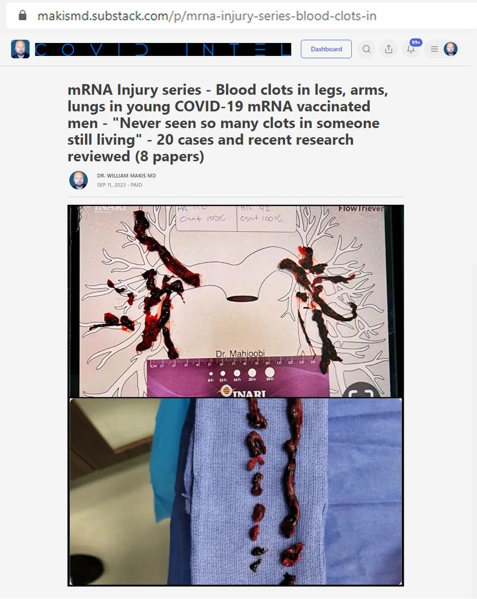 MakisMedicine's tweet photo. NEW ARTICLE: mRNA Injury series - Blood clots in legs, arms, lungs in young COVID-19 mRNA vaccinated men - "Never seen so many clots in someone still living" 

20 recent cases & 8 papers reviewed

Sep.2023 Italian study by Bernardi confirms blood clot risks of Pfizer & Moderna 

(a minimum of 1 blood clot per 10,000 mRNA jabs) and they admit that this is a underestimation

Compare to AstraZeneca and J&J which were taken off market after 3-4 clots per 10,000 jabs.

There is a huge disconnect between the 100,000s of documented cases of blood clots in the adverse reporting systems, and the published literature which usually denies any link between Pfizer & Moderna COVID-19 mRNA vaccines and blood clots.

Until 2023, most big studies denied any risk of blood clots with COVID-19 mRNA vaccines and they were usually sponsored by big pharma, or written by doctors on the payroll of big pharma.

1% of Saudi Arabian kids ages 5-18 who got Pfizer mRNA jabs, got blood clots. That's 1:100.

In 2023, studies are finally starting to acknowledge the risks of blood clots with mRNA vaccines.

Bekal et al theorize that post mRNA blood clots are caused by a different mechanism than blood clots caused by AstraZeneca, J&J.

65-70% occur in women (doctors often blame these on birth control pills)

Pfizer & Moderna have similar rate of blood clots but Moderna has much higher strokes and pulmonary emboli.

“Thrombosis associated with mRNA-derived vaccines is not yet recognized as a separate entity by formal societies. As a result, no clear guidelines or expert opinions exist on the ideal management.”

Many doctors will continue to deny these adverse events as long as they can, as doctors are legally liable for all COVID-19 mRNA vaccine injuries where they didn't properly explain the risks.

Article Link in photo to avoid shadowban, just re-type URL into your browser

#DiedSuddenly #cdnpoli #ableg