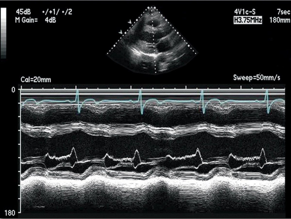 Jay Mohan, D.O., FACC, FSCAI, FASE, RPVI tweet media