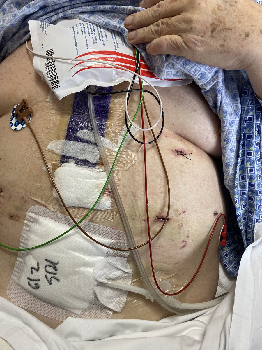 hoskinso6's tweet photo. @Wendy47802703 I had heart failure. I finally had to have surgery to have an LVAD installed. Please ask your doctor to contact Tampa General. https://t.co/tQJ1Qu68PQ