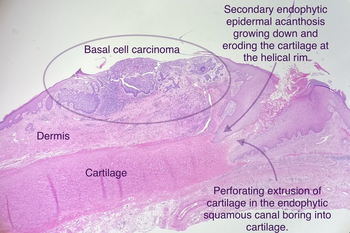 A RARE reactive but shockingly destructive phenomenon! 🤯

Basal cell carcinoma with perforating destruction of helical cartilage by endophytic squamous epithelium. (more common in CDNH)

 #dermpath #dermtwitter #pathtwitter #dermatology  #dermatologist #dermX #dermatopathology