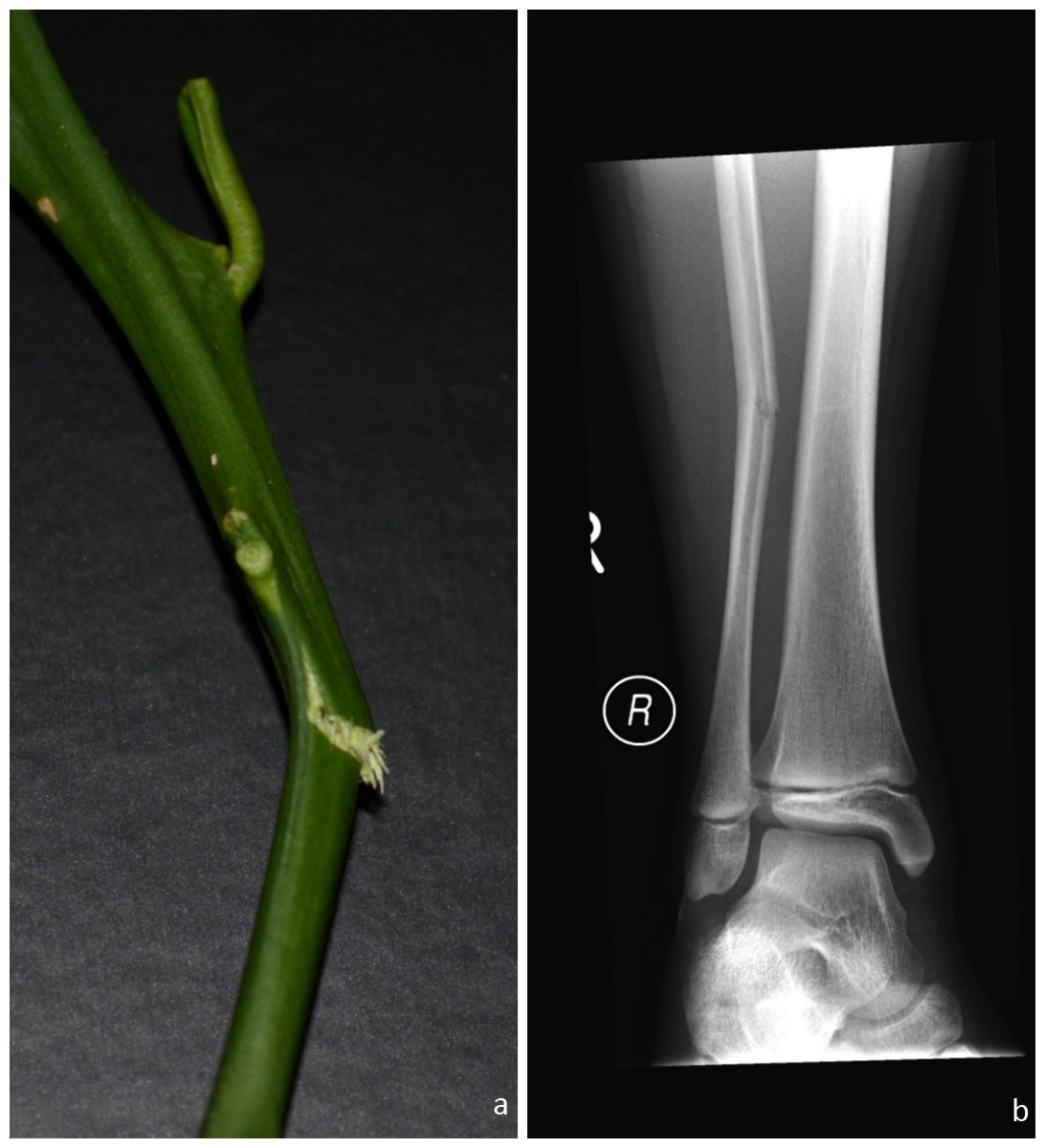 What’s the name of this fracture?