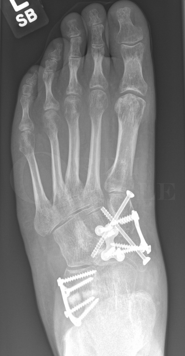 Orthoracle (@orthoracle) on Twitter photo Pes Planus correction: Lateral column lengthening & medial column fusion ( over-corrected club foot deformity)
Editors : Mr Nick Cullen FRCS(Tr & Orth) @rnohnhs & Mr Mark Herron FRCS(Tr & Orth) <a href="/orthoracle/">Orthoracle</a>
Full surgical technique : orthoracle.com/library/pes-pl…
#orthotwitter Pes Planus correction: Lateral column lengthening & medial column fusion ( over-corrected club foot deformity)
Editors : Mr Nick Cullen FRCS(Tr & Orth) @rnohnhs & Mr Mark Herron FRCS(Tr & Orth) <a href="/orthoracle/">Orthoracle</a>
Full surgical technique : orthoracle.com/library/pes-pl…
#orthotwitter