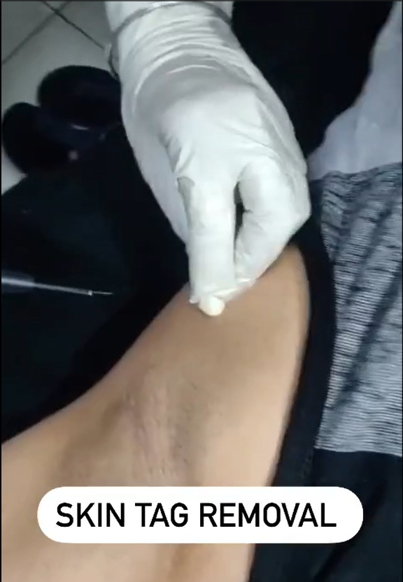 Embracing the journey to skin wellness and bidding farewell to unwanted skin tags.✨

Check out video: instagram.com/reel/CwagPg5K-…

#microblading #skintag #skintagremoval #skintags #skintreatement #divineskinclinic #divine #divineskincare