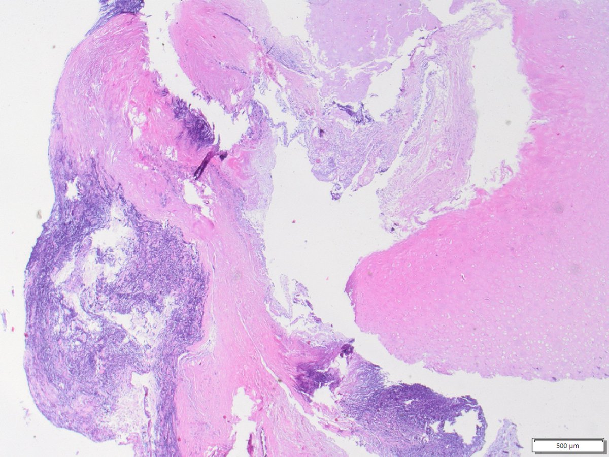 What is the problem in this bronchial anastomosis after LungTx? #PathTwitter #CrittersOnTwitter #ThoracicPathology