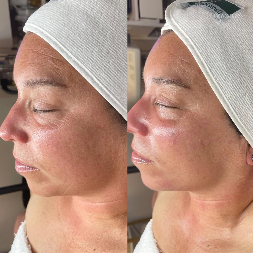 DMKIntlHQ's tweet image. Ready to take the plunge and begin your #DMKJourney? 

Estheticians: leave a "🥼" in the comments for more information on getting #DMKCertified

📸 @thewaxcutie1

#SkinCondition #SkinTreatment #BeforeAndAfter #DiscoverDMK #DMKEnzyme
