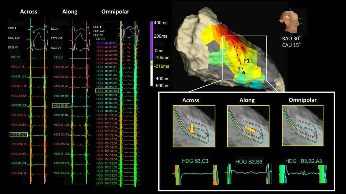 Directional dependence of bipolar electrograms (i.e., bipolar blindness) is one of the causes of unrecordable P1 potentials. The HD Grid catheter and Omnipolar Technology help uncover the P1 potentials during LPFVT.
@HRS_CaseReports  #EPeeps
heartrhythmcasereports.com/article/S2214-…