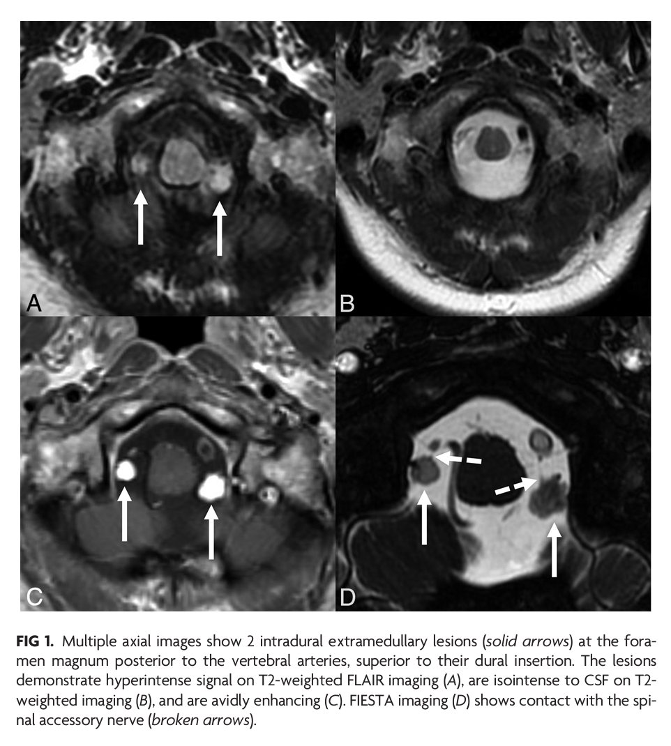 'Benign Enhancing Foramen Magnum Lesions' #RadPathCorrelation #OpenAccess @iantmark | bit.ly/3PcaRFG