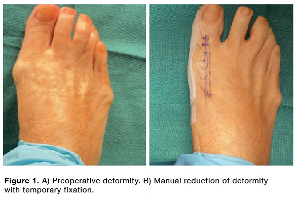 BRAND NEW DATA on value of HEMIGARD closure system! HEMIGARD Interlock offloads tension from wound edge to prevent complications and now also effective in reducing hallux drift following bunion correction: zurl.co/M9Bl #hemigard