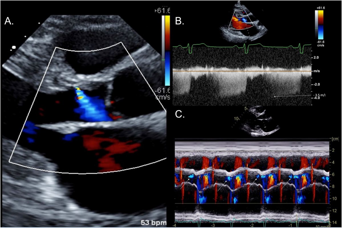 Hypertrophic cardiomyopathy is frequently unrecognized or misdiagnosed. We provided a practical framework for optimal image & measurement acquisition & guidance on how to tailor the echocardiography examination for individuals with #HCM. bit.ly/3VRYz8t @JournalASEcho