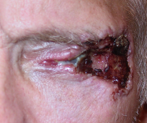 aao_ophth's tweet photo. Save the date. Join #Ocular specialists on Thu., 9/14, for The 2023 Update on Ocular Oncology webinar. Explore the latest advancements in ocular surface neoplasia, therapies for #periocular tumors & more. Academy member benefit. https://t.co/UFpChKjWMY https://t.co/f2YZgyb2CE