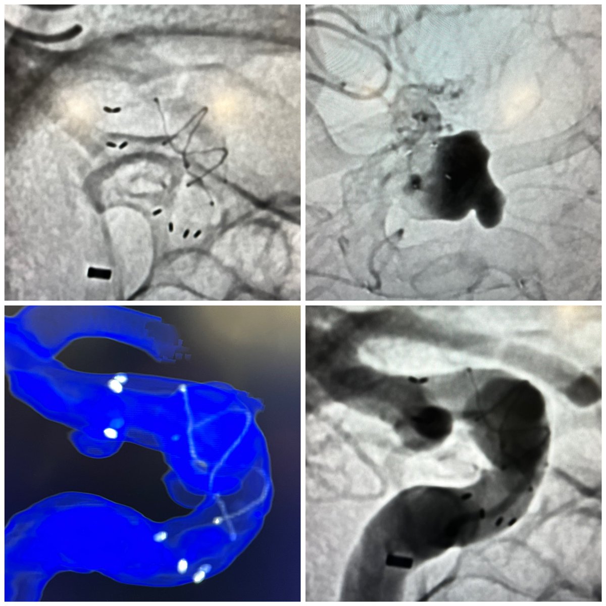 JanKarlBurkhar1's tweet photo. Case perfect today LIVE from #Cerebrovascular #KimFamily @PennMedicine to Washington DC #2023CNS @CNS_Update #FREDX #flowdiverter @MV_Terumo
Smooth deployment, precise placement, lots of stasis, strong team effort, patient doing well, great moderation @visishs @PennNSG @eerman61 https://t.co/KiU5ZF3pIw