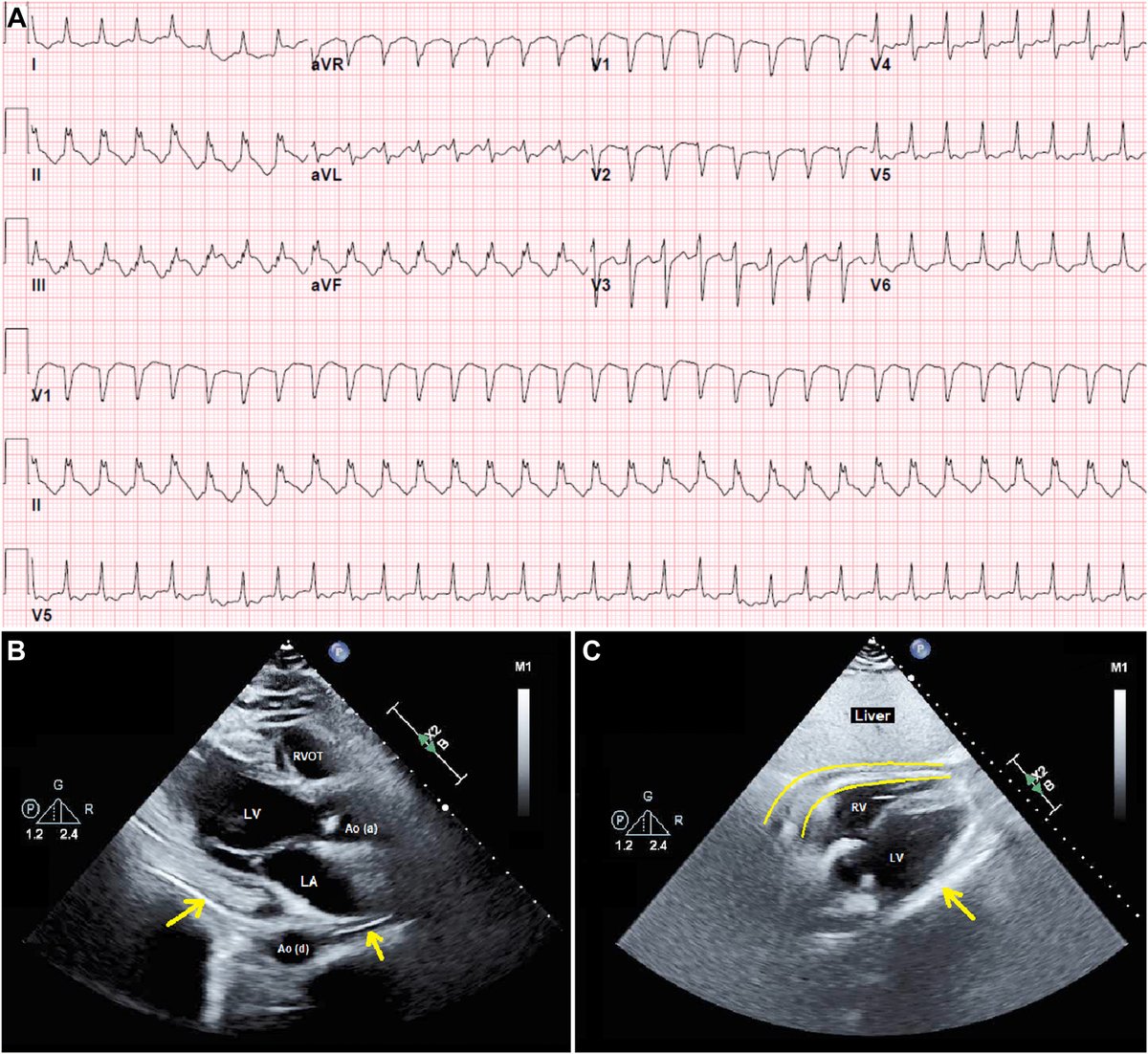 A case of Epstein-Barr virus–associated pericarditis progressing to complete atrioventricular block and cardiac arrest heartrhythmcasereports.com/article/S2214-…