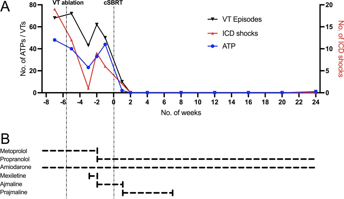 HRS_CaseReports's tweet photo. Recurrent ventricular tachycardia originating from the "LV summit" effectively eliminated by stereotactic irradiation - a case report https://t.co/KjLN7zBNE5 https://t.co/mDvNLvw2mH