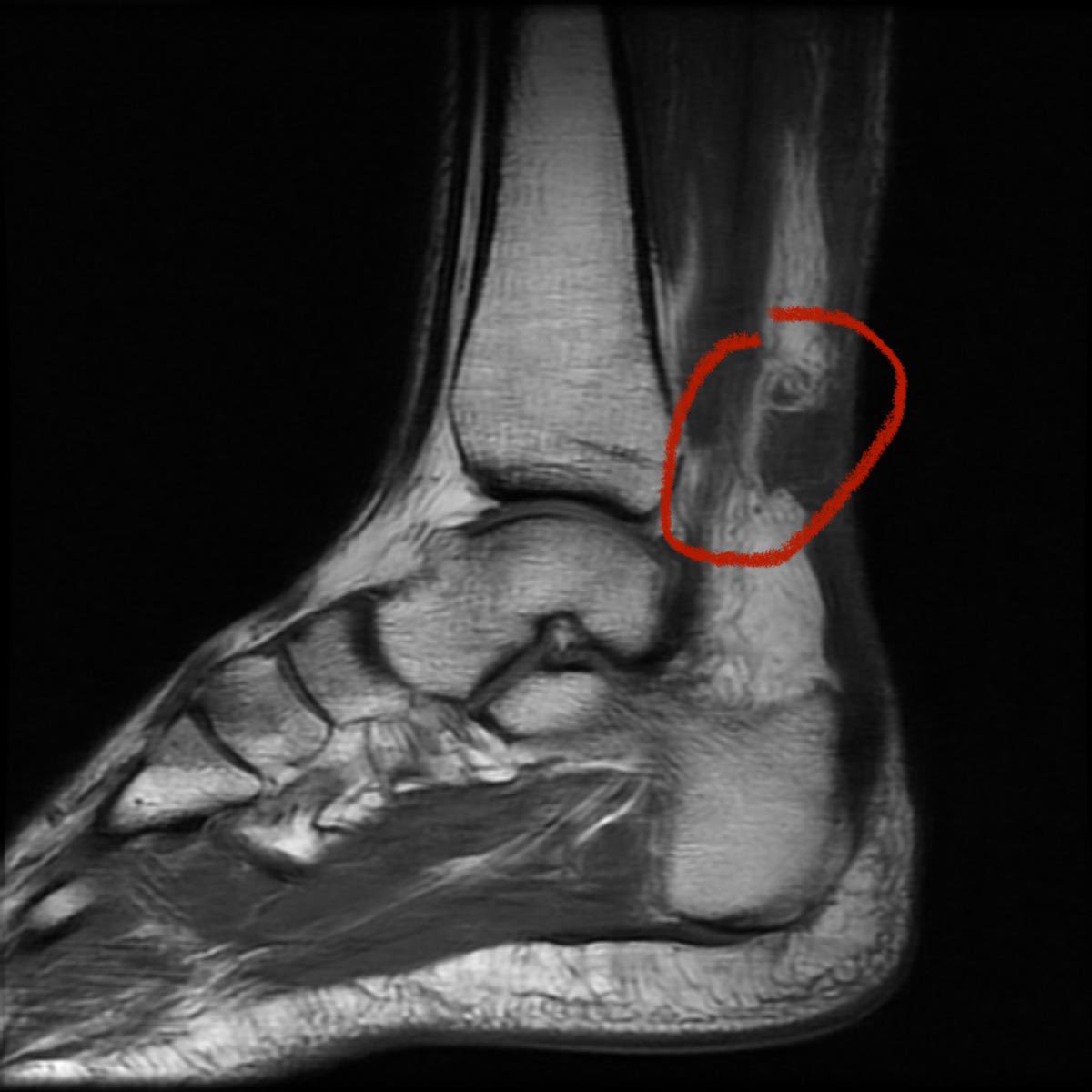 Yo <a href="/SStricklandMMA/">Sean Strickland</a> I tore my Achilles tendon cheering for you when you knocked down Izzy in the first round on Saturday night 😂😂😂

Can I get some love on this post 😂