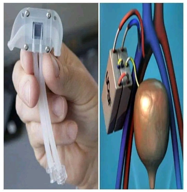 UniqueInfo49ja's tweet photo. The era of dialysis could be coming to an end with the development of a Bio Kidney.

Scientists from the University of California, USA, are working on developing the world’s first bionic kidney which might replace damaged kidneys easily and effectively. https://t.co/cF5RgEnmGa