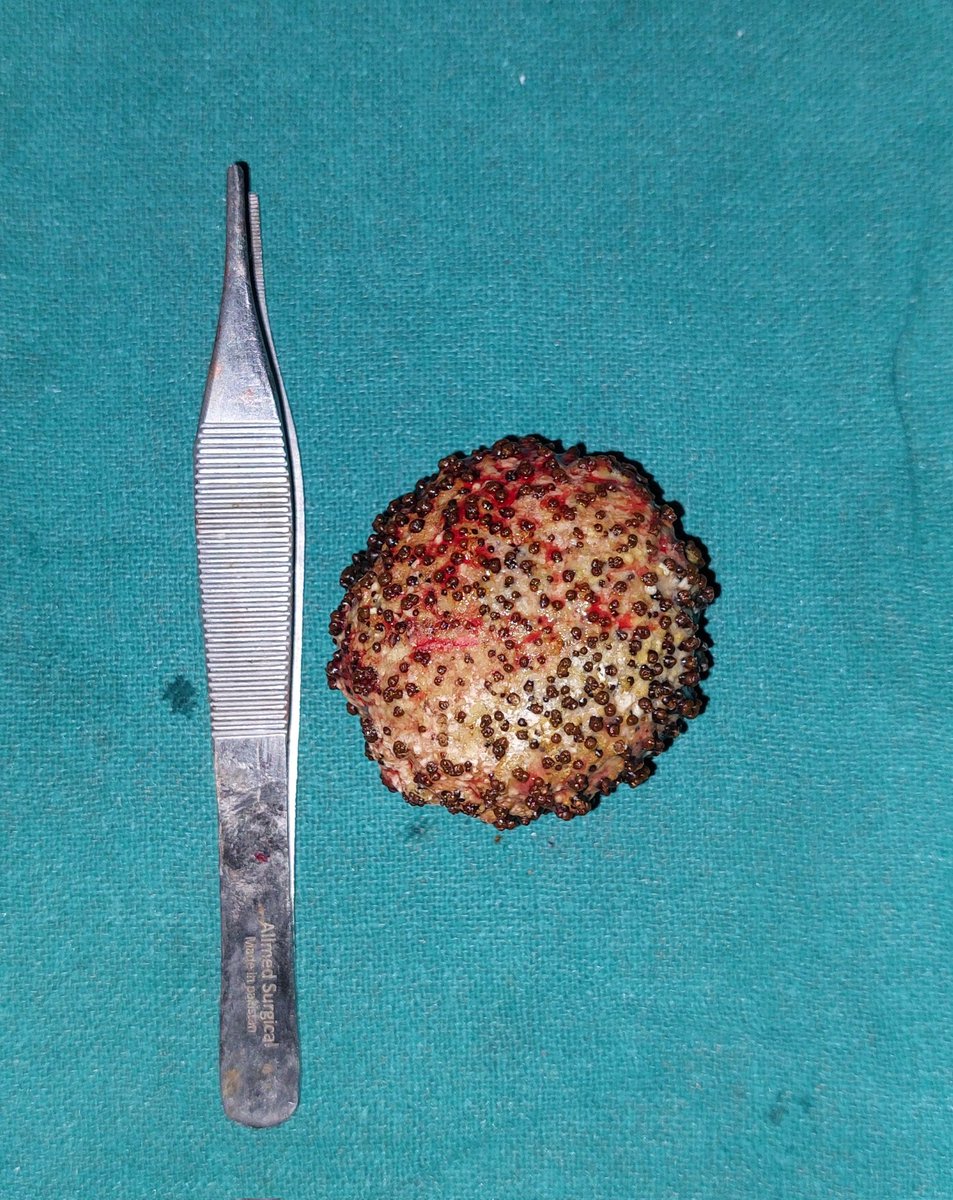 Encountered a massive bladder stone!  😲 Take care of your urinary health , stay hydrated!