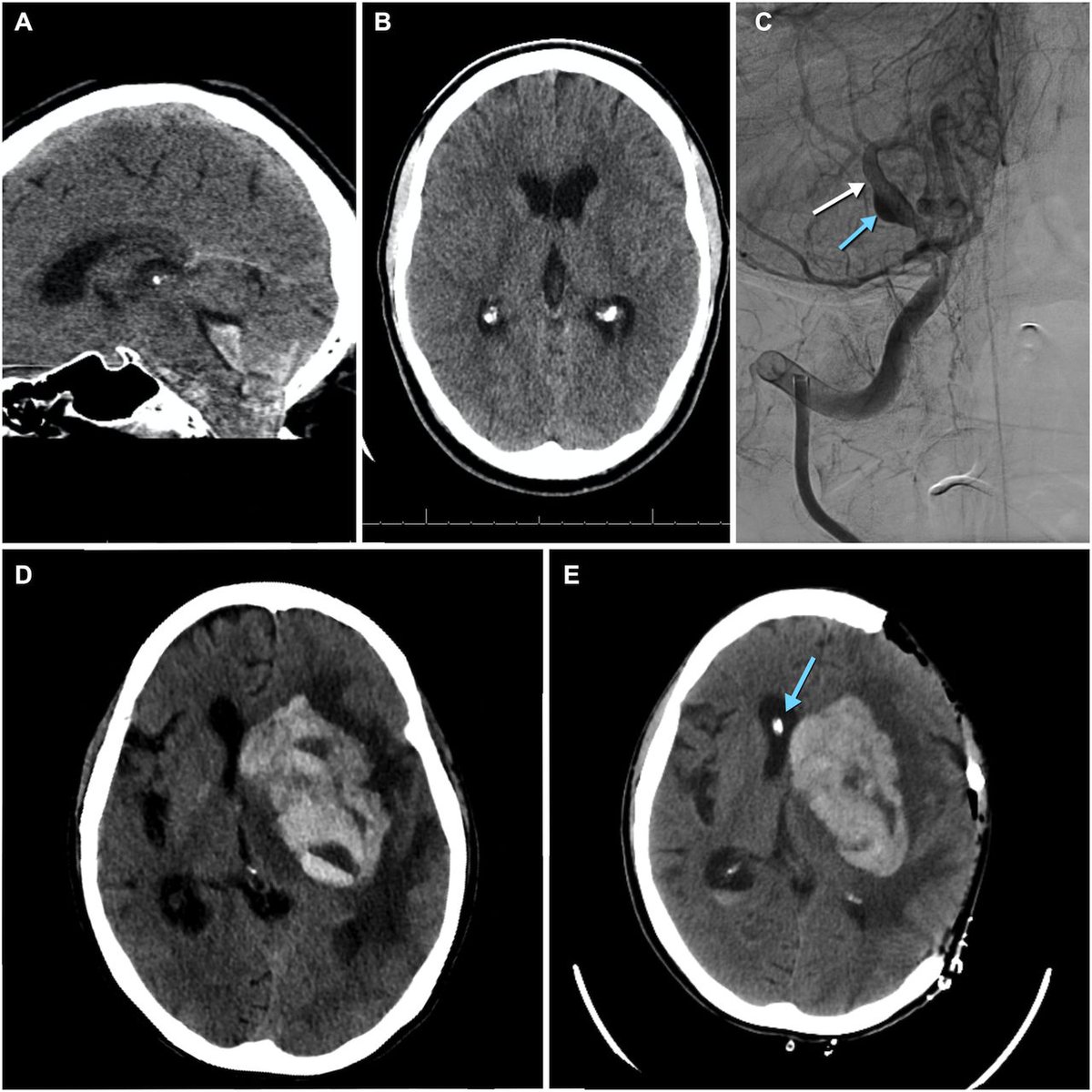 9) Slovakian researchers reported the presence of SARS-CoV-2 in the cerebrospinal fluid of patients with long covid.
journals.sagepub.com/doi/10.1177/20…