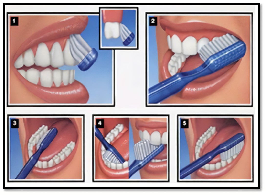 TOOTH BRUSHING TECHNIQUE
Step 1: Start with outer and inner surfaces, and brush at a 45-degree angle in short, half-tooth-wide strokes against the gum line. Make sure you reach your back teeth. #dental #dentalcare #dentistry #FrontierdcRW #RwOT #RwotGain #kigali #Rwanda