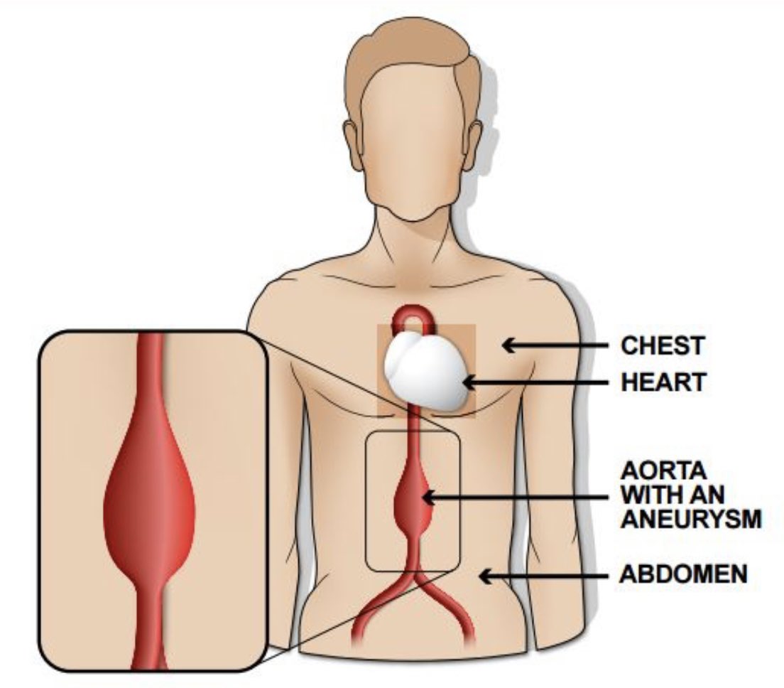 #VascularAwarenessMonth facts continue!

An abdominal aortic aneurysm is a swelling in the tummy blood vessel and 6x more common in men

There is a free screening programme for men aged 65!  

&lt;3cm no AAA
3-5.4cm regular scans
&gt;5.5cm refer to vascular

nhs.uk/conditions/abd…