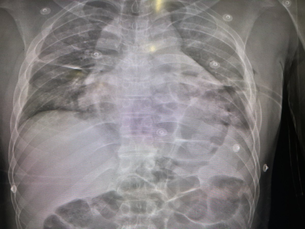 Driver ejected from car with colon in the chest from a ruptured diaphragm.