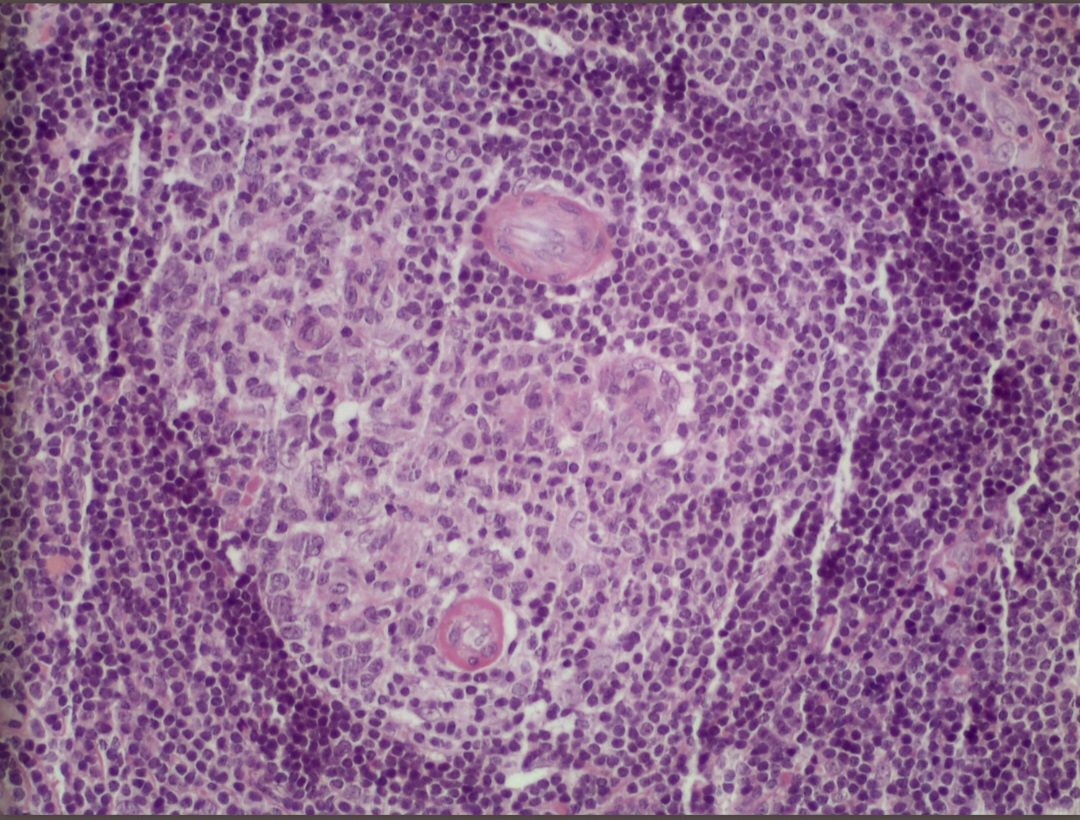 khalafalla71's tweet photo. Castleman Disease
Some important features
(1):  
Mantle zones fuse and contain more than 1 germinal center - twinning.
(2): 
In the interfollicular areas: extensive vascular proliferation of high endothelial venules with perivascular hyalinization
#HemePath #Pathology https://t.co/zywb1mFGJv