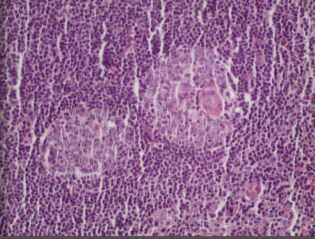 khalafalla71's tweet photo. Castleman Disease
Some important features
(1):  
Mantle zones fuse and contain more than 1 germinal center - twinning.
(2): 
In the interfollicular areas: extensive vascular proliferation of high endothelial venules with perivascular hyalinization
#HemePath #Pathology https://t.co/zywb1mFGJv