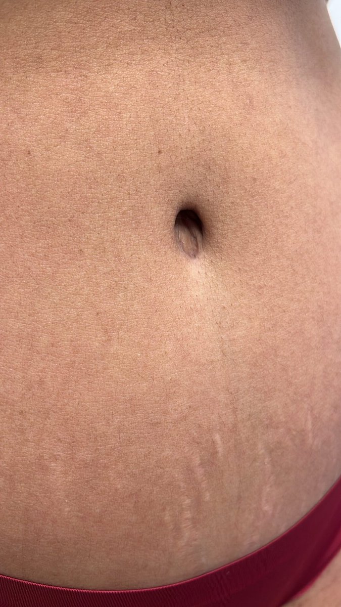 RealDrOPP's tweet photo. Would you think this was a tummy tuck if you didn’t already know? 🧐 https://t.co/chSgVjbEdN