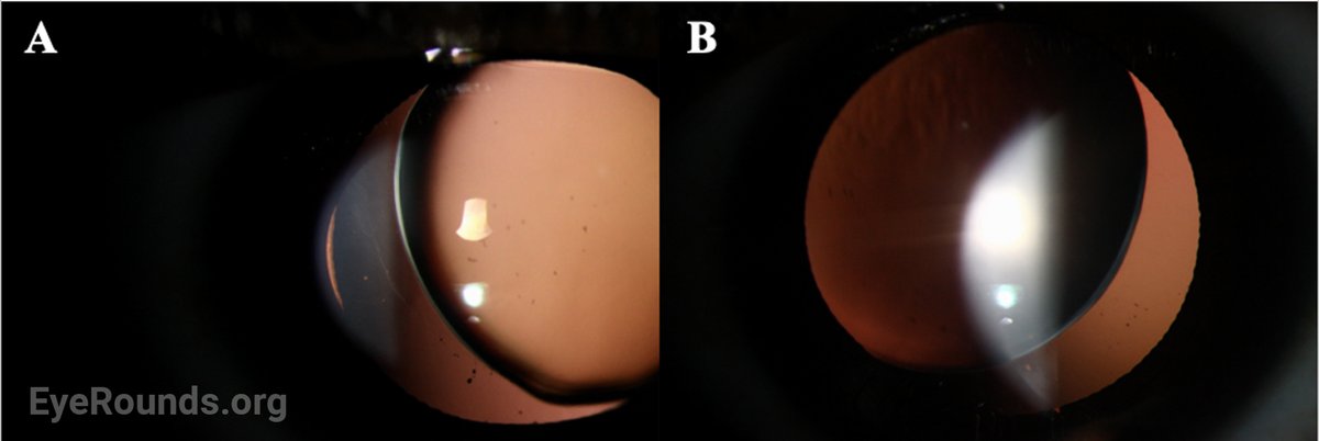 What congenital disorder presents with lens abnormalities, glaucoma, short stature, brachydactyly, joint stiffness, and cardiovascular defects?

Find out here!
webeye.ophth.uiowa.edu/eyeforum/cases…

<a href="/uiowaeye/">UIowa Eye</a> @WNajdawi <a href="/SRodsAndCones/">Sean Rodriguez, MD</a> <a href="/MortensenMd/">Zachary Mortensen, MD</a> <a href="/andrewpouw/">Andrew Pouw</a> <a href="/ScottLarsonMD/">Scott Larson, MD</a>