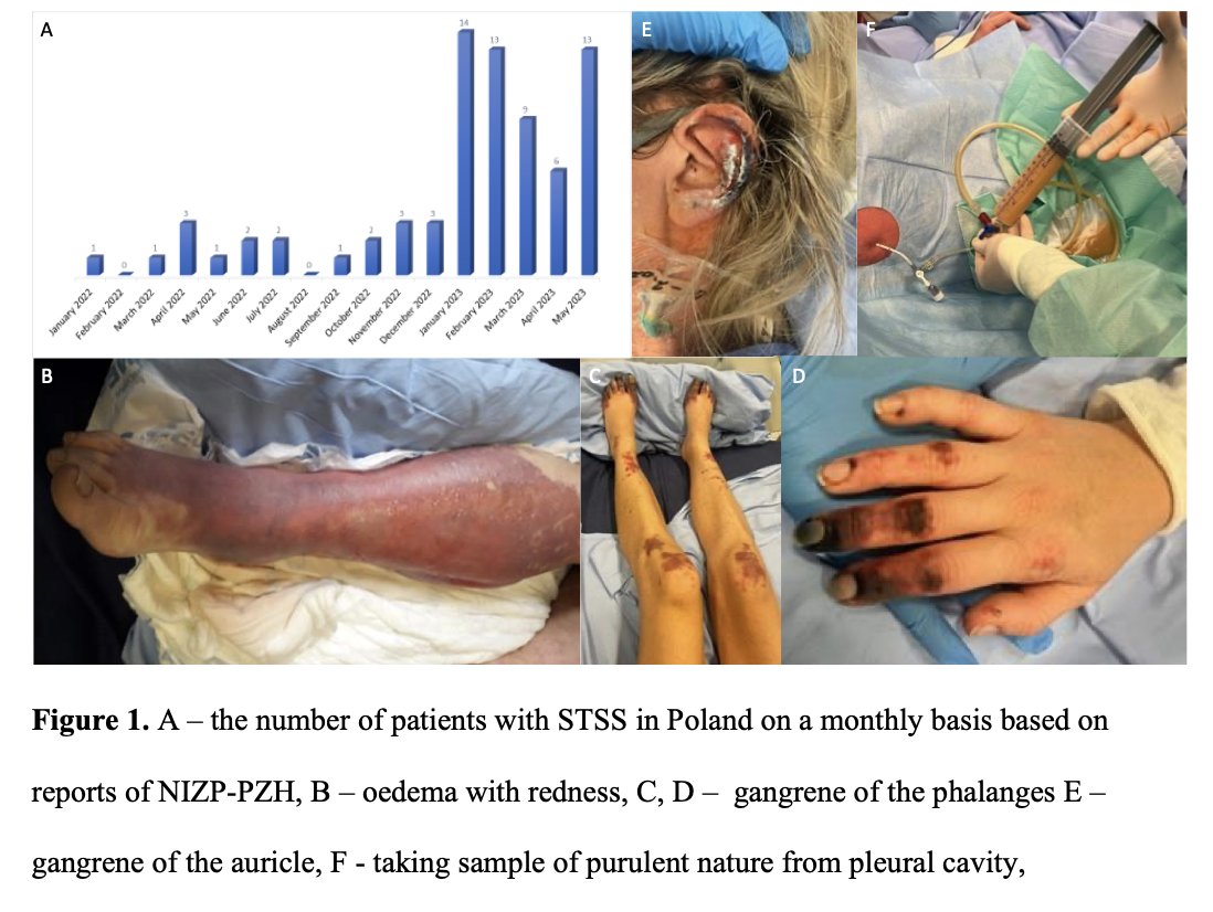 W bieżącym roku obserwowaliśmy znacznie więcej groźnych zakażeń z udziałem paciorkowców typu A (Streptococcus pyogenes, GAS). Niestety wiele z nich miało ciężki i nietypowy przebieg - oprócz zajęcia płuc obserwowaliśmy często ciężkie zajęcie tkanek podskórnych i oporny na…