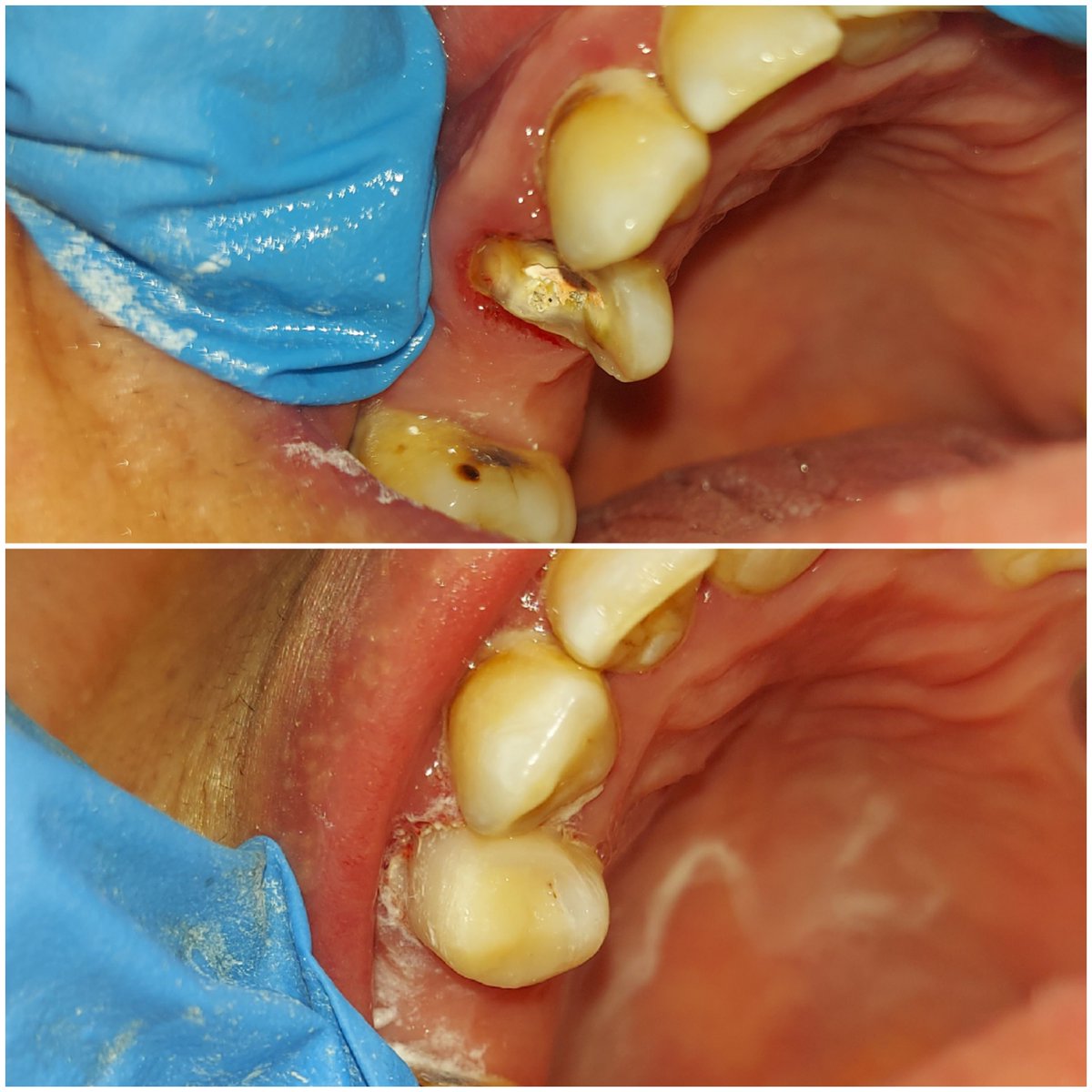 A7mee_d_M's tweet photo. From Endo To Resto (build up)🥰🦷🔥
#dentistry https://t.co/MpKmr3Vjty