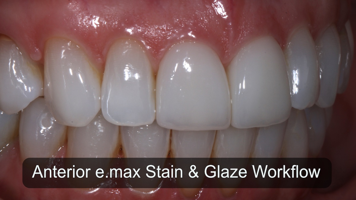 Stain and Glaze Workflow for an Anterior e.max