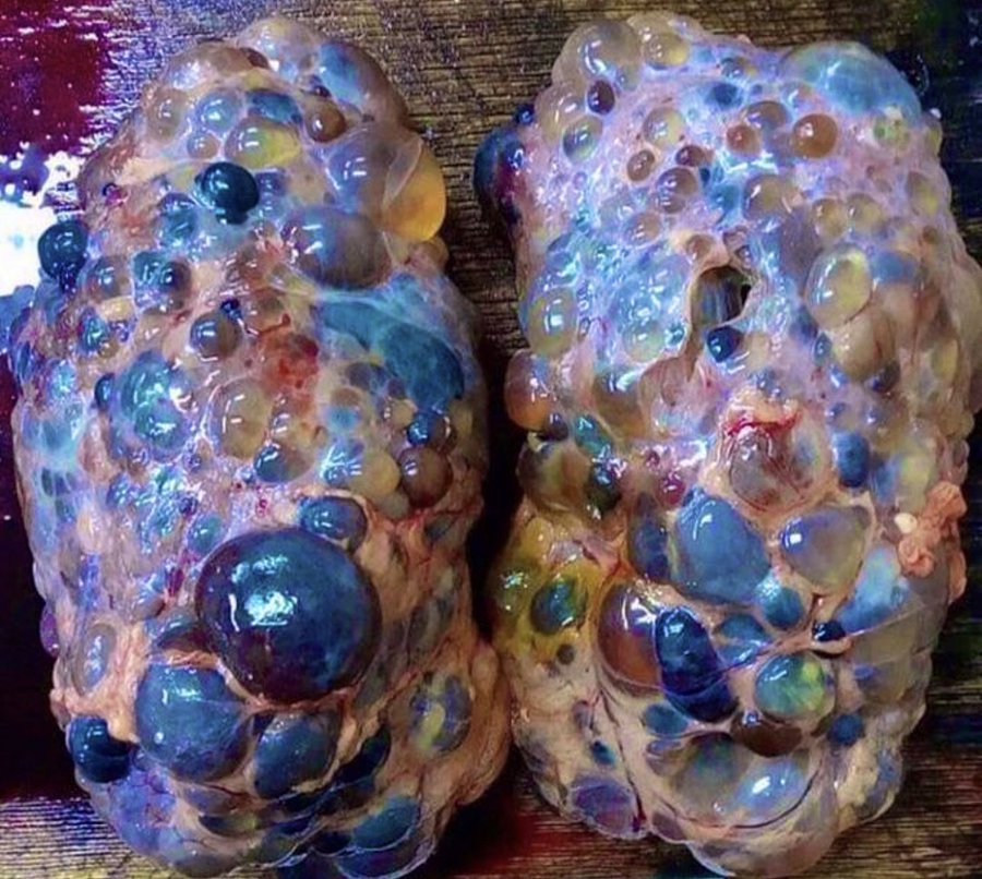 <a href="/drkeithsiau/">Keith Siau</a> 💠Polycystic Kidney Disease (PKD):
✅Dx:
1️⃣Two main types➡️ADPKD &amp; ARPKD.
2️⃣Autosomal dominant polycystic kidney disease.
3️⃣ADPKD ocurrs between 30s-40s.
4️⃣Autosomal recessive polycystic kidney disease
5️⃣ARPKD less common, often appears shortly after birth
<a href="/IhabFathiSulima/">Dr Ihab Suliman</a>
