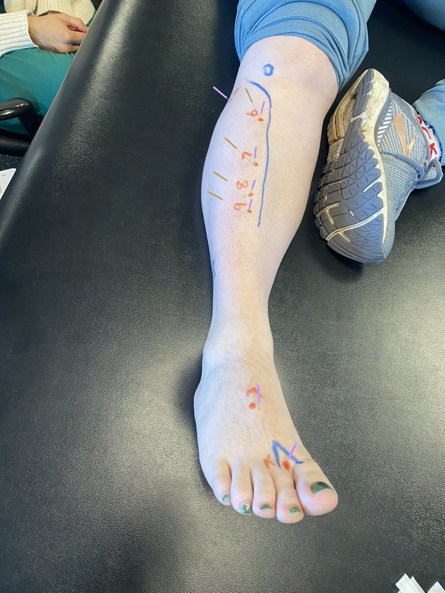 Awesome time teaching my first course in Washington state! Great opportunity for Washington’s practitioners (and their patients) to get the non pharmacological pain relieving treatment they need! #DryNeedling #Osteopractor #PhysicalTherapy