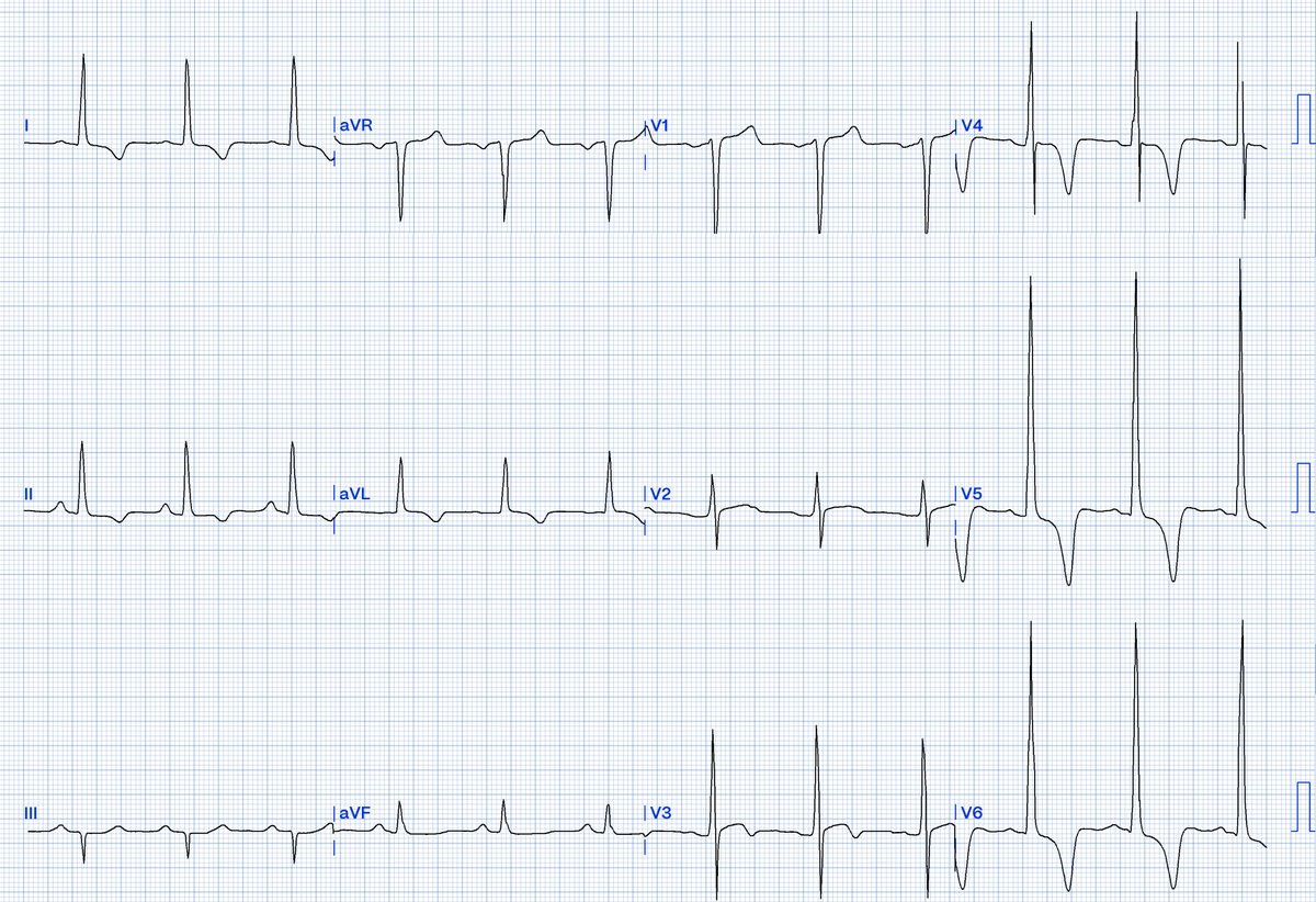 oslertech's tweet photo. A 56 year old man presents with exertional dizziness, a murmur and an abnormal ECG.
What does the ECG show?
https://t.co/r0s9vFXHWK
#meded #medstudents #medstudenttwitter #medtwitter #medschool #juniordoctors #tipsfornewdocs #tipsfornewinterns #juniordocs #FOAMed #FOAMcc https://t.co/1KmvkcAUUb