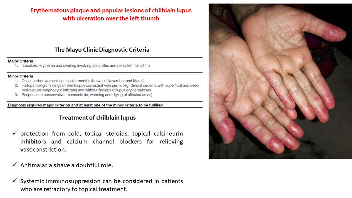 MJR_journal's tweet photo. #Chilblainlupus Hutchinson lupus/perniotic lupus ✅Rare form of cutaneous #SLE 
✅Mildly tender, pruritic, erythematous lesions typically involve acral surfaces
✅Nose/ears are less frequently affected
✅Anti-Ro antibodies
Read the full clinical case 👉https://t.co/ivfInnh3hD https://t.co/ggeLA5NAyt