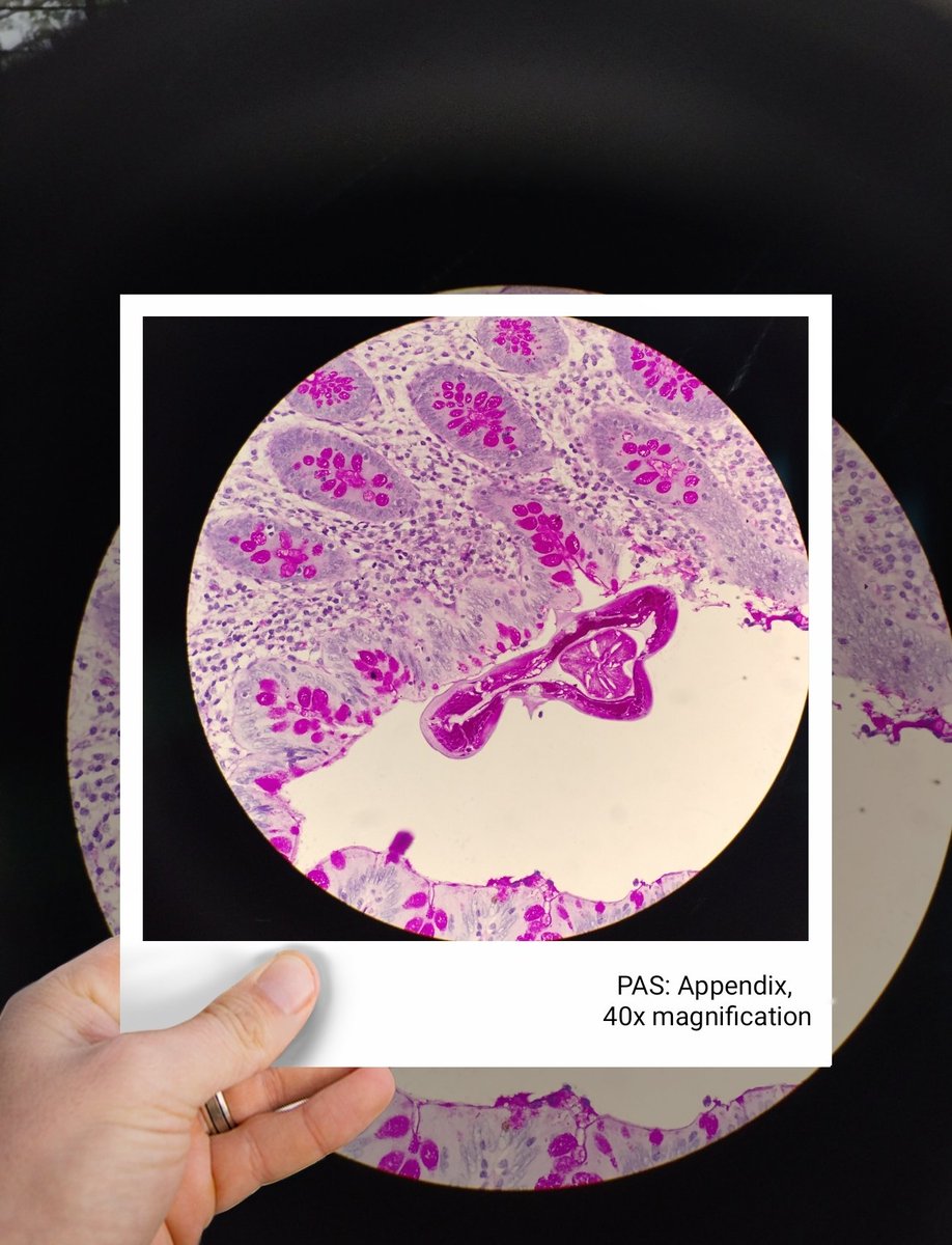 A 7 year old male came with pain in the right iliac fossa.
#KAPCONPathX2023 
#KAPCON2023
#PathX #pathology #histology #histopathology