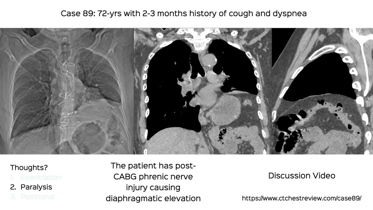 bhavinj's tweet photo. Case 89: Diaphragmatic Dysfunction - Eventration, Paralysis...Does it Matter?

72-yrs post CABG. 

The answer is 
2. Paralysisl

Discussion video
https://t.co/eSm5cHURLJ

#ref #caferoentgen #chestrad #ctchest #FOAMrad #radres #diaphragm #eventration https://t.co/3Ju1QGsYEb