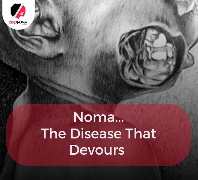 ZeronomaAfrica's tweet image. Indeed, it #devours the human face leaving huge defect. We must #prevent it and help survivors overcome the #stigma it causes

#zeronoma
#beatnds 
#NNN2023