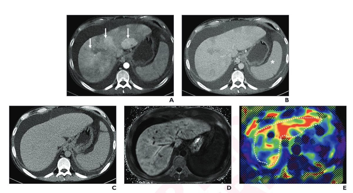 This is the best review I've read on IMAGING in alcohol-related liver disease: 🔸Indications & limitations of all techniques 🔸Practical examples: 'Patchy fat resembling tumor infiltration in alcohol-associated hepatitis' shorturl.at/zJMT5 #livertwitter #MedTwitter