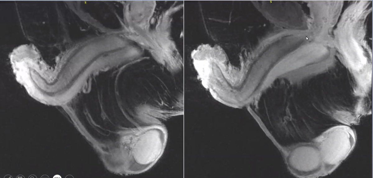 MayoUrology's tweet photo. Today’s #MondayMorningConference question. 67 yoM p/w distal penile mass, punch biopsy shows SCC, no palpable inguinal nodes, cT1b. Preop MRI shown below. If proceeding with partial penectomy, what else is indicated? Multiple choice question in next thread. https://t.co/NmGs6nnQZ2