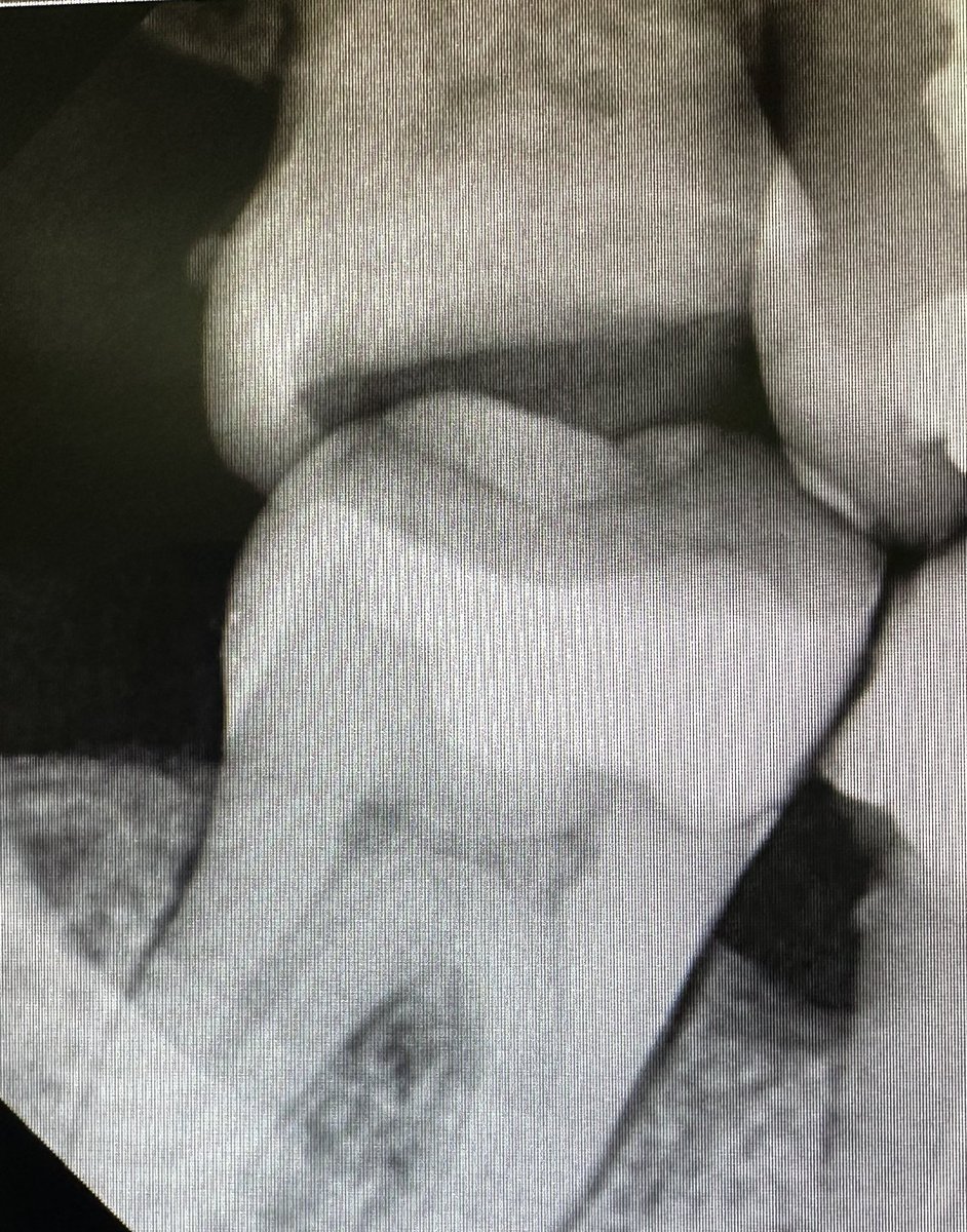 MO #47  ✨

reccurent caries under old amalgam restoration 

Restored with composite restoration